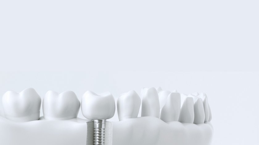 Protesi dentali e impianti